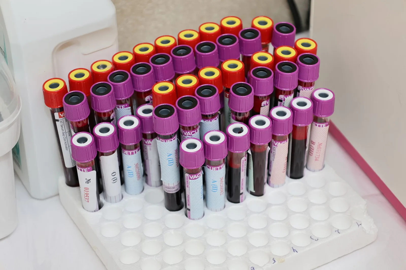 Mẫu máu được xét nghiệm phát hiện gen Thalassemia